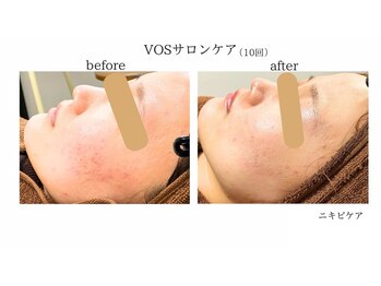 アボット(ABBOTT)/VOSサロンケア