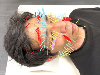 とだ鍼灸院/《立体的な小顔◎美容鍼 200本》
