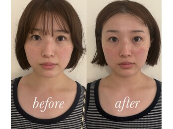 マホロバ(mahoroba)/美容鍼+EMS