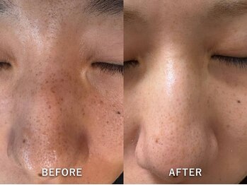 エリンダ(E LINDA)/メラニンケア