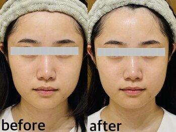 メナードフェイシャルサロン 西五反田/小顔/トーンUP/引き上げ