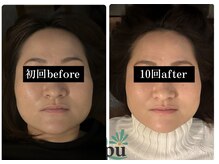 キュープ 福岡天神店(Qpu)/通常コース４回での変化