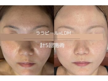 ライフサロン 恵比寿(Life Salon)/《モニター》ララピール×LDM