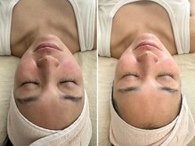 マヴィ 香里園店(MavY.)/ノンニードル水光注入