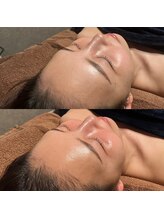 マヴィ くずは店(MavY.)/ハーブピーリング