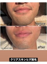 シンバ 倉敷店(SIMBA)/【ド定番】クリアスキンヒゲ脱毛