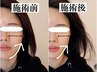【リフトアップコース】ダウンタイムなしの短時間で小顔に