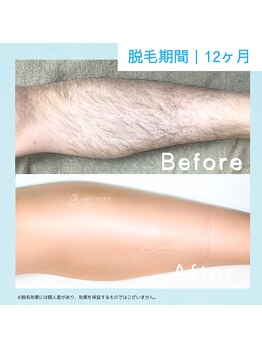 メンズクリア 上野店/【メンズクリア】お客様の施術例