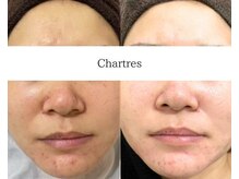 シャルトルズ/《症例写真》実感重視の施術