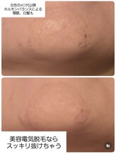 ベビースキン(baby skin)/美容電気脱毛