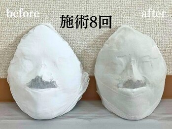 コルギサロン 伏見店(k_korugi.salon)/小顔コルギ　before after