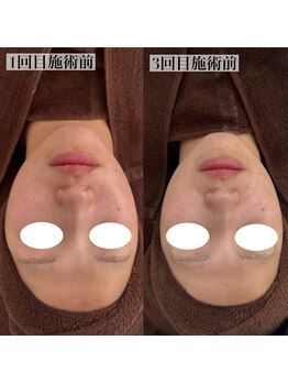 テンニック(10nick)/【頬の赤み】