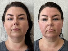 さつま骨格矯正 渋谷 恵比寿本院/ロサンゼルスでの初回効果