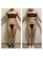 ホズリル(Hozril)/2ヶ月集中　夏まで全身痩身