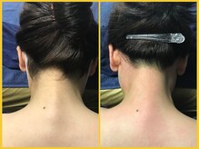 クラウン ジュエルズ(CROWN JEWELS)/【Wax脱毛】うなじ　正面 7