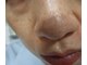 クリニカルエステクリア 梅田店の写真/「黒ずみ・詰り・開き…年齢と共に毛穴が目立つ」そんなお悩みに
プロの毛穴ケアで見せたくなる素肌へ

