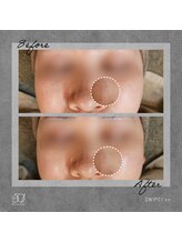 ゴーマルイチ(501)/プラズマシャワー　Before/After