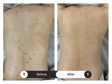 リジュ(Reje)/ 背中ケア