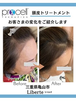 リベルテ(Liberte)/プロセル頭皮トリートメント