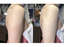 スリリアン 銀座/★ニキビ劇的ビフォーアフター★