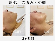 ランティル(l’until)の雰囲気（50代お顔の脂肪・たるみ・二重あごもすっきりフェイスラインに！）