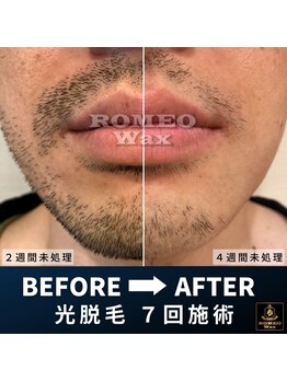 ロミオワックス 渋谷店(ROMEO Wax)/ヒゲ脱毛 ビフォーアフター7回目