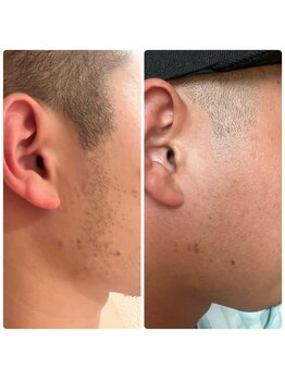 シアンビビ(Cyaan bibi)/men's 顔脱毛（もみあげ）