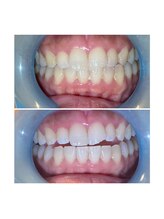 ボンダイボディー(Bondi Body)/セルフホワイトニング