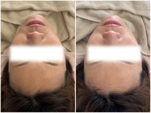 マヴィ くずは店(MavY.)/たるみ、シワ改善