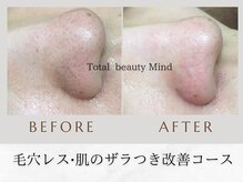トータルビューティー マインド(Total Beauty)/毛穴レス肌のザラつき改善コース