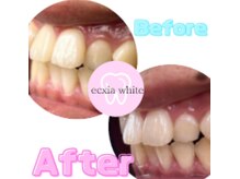 エクシアホワイトニング 可児店/ビフォーアフター