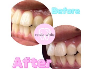 エクシアホワイトニング 可児店/ビフォーアフター