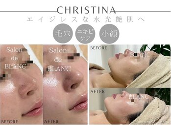 サロン ド ブラン アオヤマ(Salon de BLANC AOYAMA)/剥けないハーブピーリング