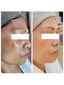 リセル(RE.cell)/シミケア6回+肌質改善6回後