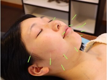 なみつき鍼灸整骨院の写真/痛みの少ない美容鍼灸と鍼灸メニューをご用意◎なかなかとれない疲れやダルさを解消致します！