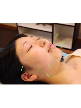 鍼灸施術を受けたい