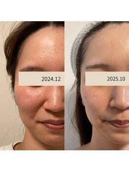 ひっそり美肌構築/ブライダル♪