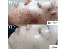 繰り返すニキビは集中プログラムで根本改善