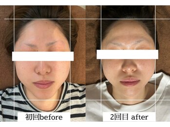 ダイアリー(DIARY)/小顔矯正