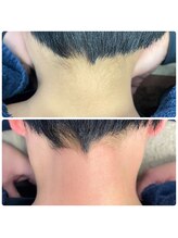 リュクス(Lux'or)/Wax脱毛