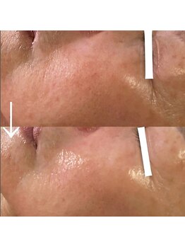 マイン 幸店/毛穴リメイク＆高濃度水素洗浄