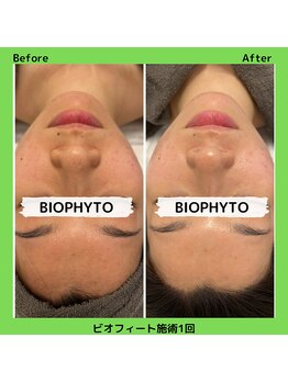 アガットバイミヤモト(agate by miyamoto)/ビオフィート(毛穴)施術1回