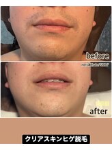 シンバ 倉敷店(SIMBA)/【ド定番】クリアスキンヒゲ脱毛