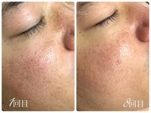 シェミー(CHEZ MEE)/【メンズ美容】毛穴洗浄/赤ら顔