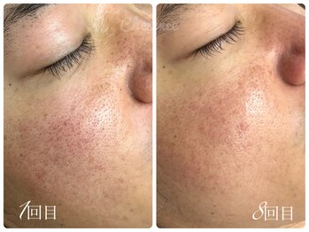 シェミー(CHEZ MEE)/【メンズ美容】毛穴洗浄/赤ら顔