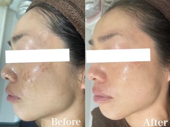 パールホワイトニングサロン 平塚店/くすみ/毛穴/シミしっかりケア