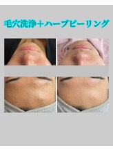 シャイニー(SHINY)/ハーブピーリング＋毛穴洗浄