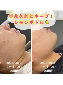 フレル(FUREL)/半永久的に持続が最大の魅力