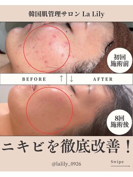 ラ リリー ステラ(La Lily stella)/ニキビにはもう悩まない!