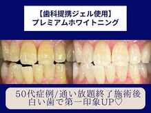 ホワイトニングカフェ 岸和田店(WhiteningCafe)/◎歯のホワイトニング施術写真◎